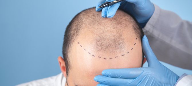 Hårtransplantation hos 85kliniken – Vad metoderna erbjuder och hur det fungerar